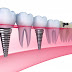 Thực hiện cấy ghép răng Implant có đau hay không?