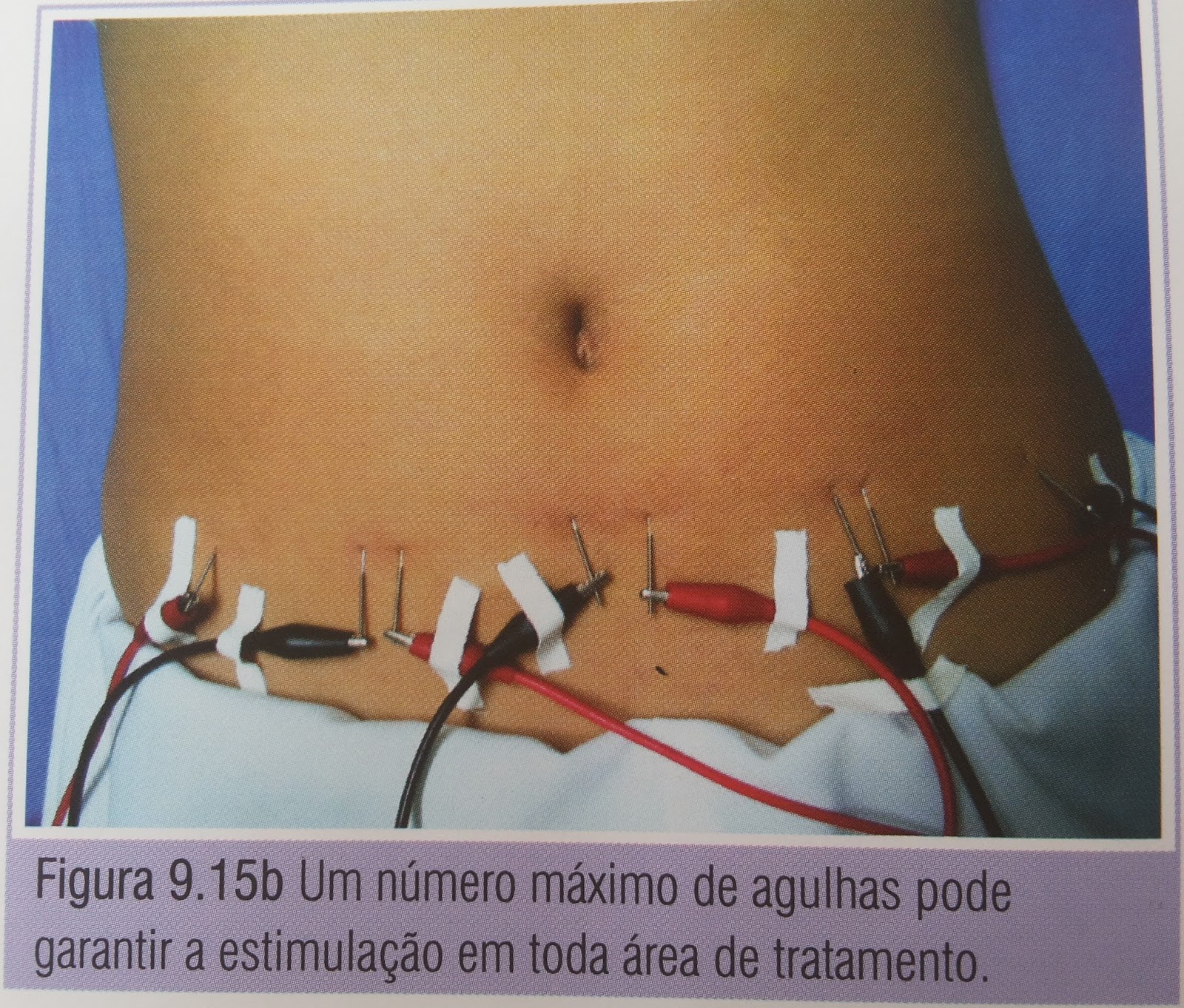 Clube da Estética : Já conhece a Eletrolipólise?