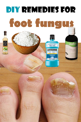 DIY remedies for foot fungus | Healthistas