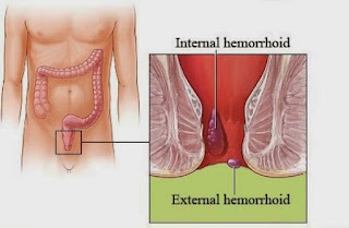 Obat Wasir Alami Paling Mujarab di Apotik