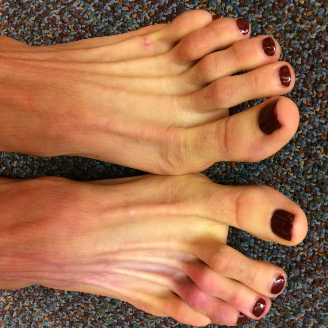 Foot and Ankle Problems By Dr. Richard Blake Skin and Subcutaneous Fat