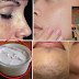 Simple and Effective Home Remedy to Remove Dark Spot