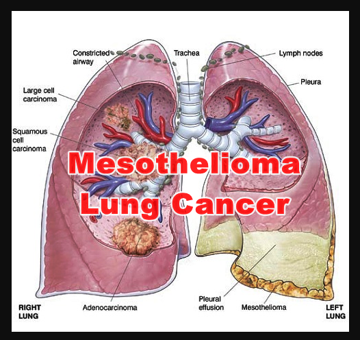 Breathtaking Is Mesothelioma Lung Cancer Abstract Illustration