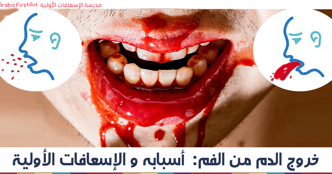 مفيد عاصمة تشكيل تكوين خروج دم من الفم عند الاستيقاظ من النوم Findlocal Drivewayrepair Com