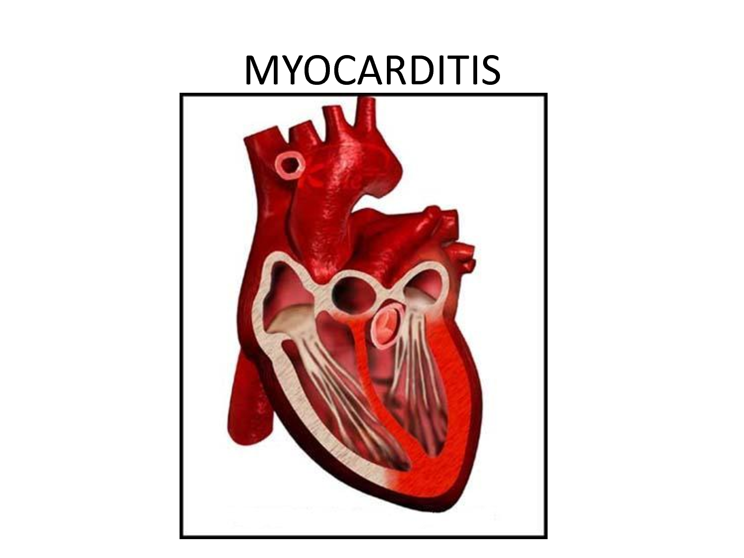 myocarditis - photo #6