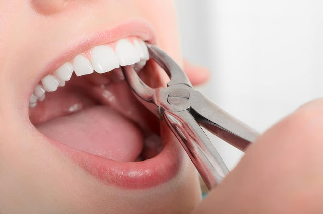 Alasan Dokter Gigi Tak Mau Cabut Gigi Saat Masih Sakit, Ternyata Efeknya Mematikan