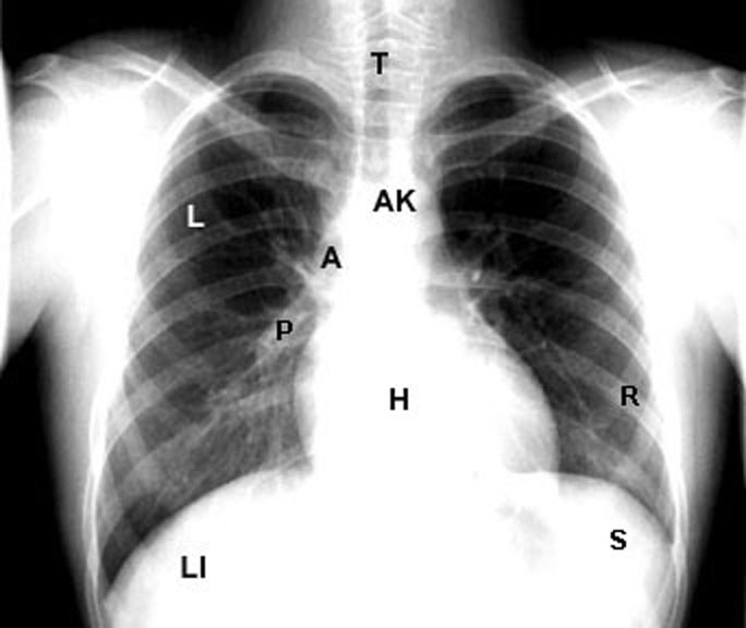 clinical images Chest X ray PA normal lebelled