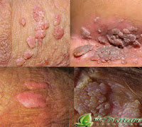Obat Menyembuhkan Kutil Kelamin Secara Ampuh Tidak Muncul Lagi Obat Menyembuhkan Kutil Kelamin Secara Ampuh Tidak Muncul Lagi
