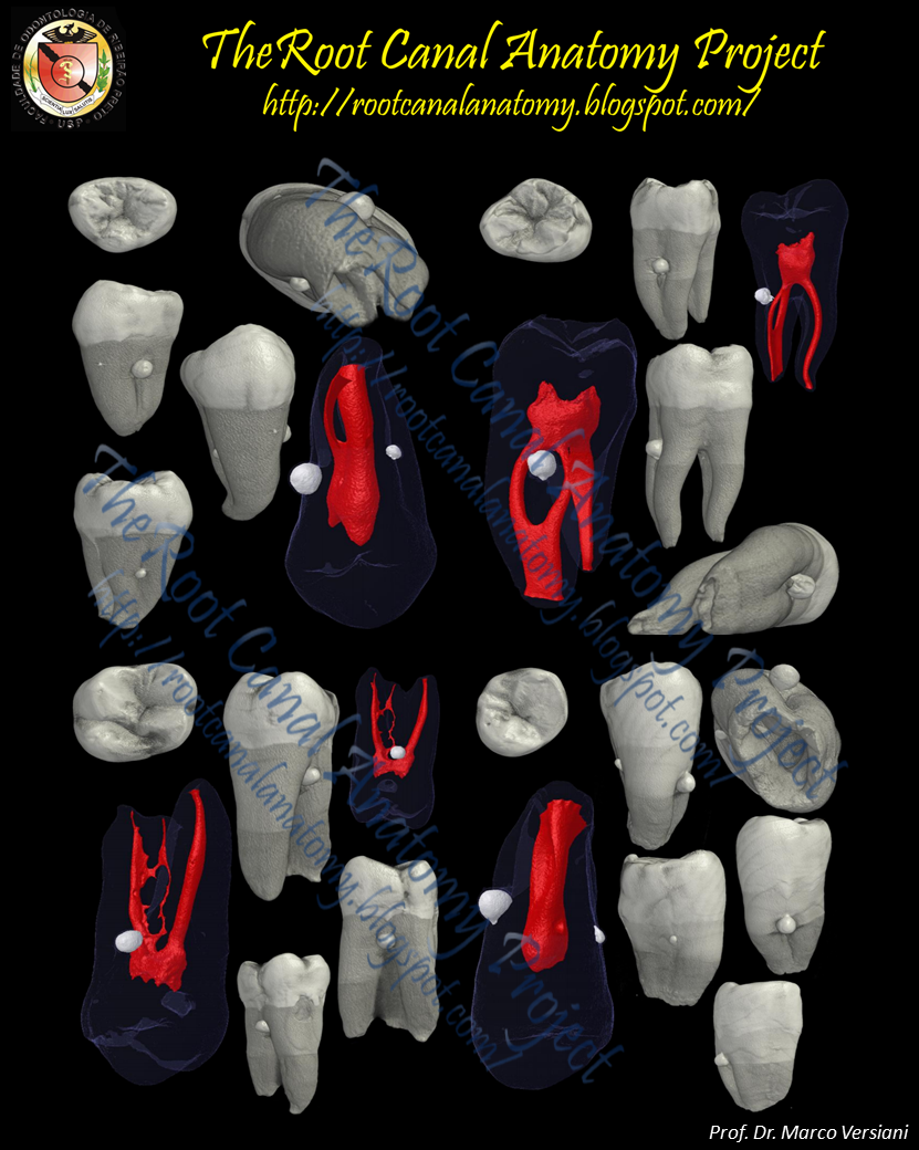 The Root Canal Anatomy Project Enamel Pearls in Permanent Dentition
