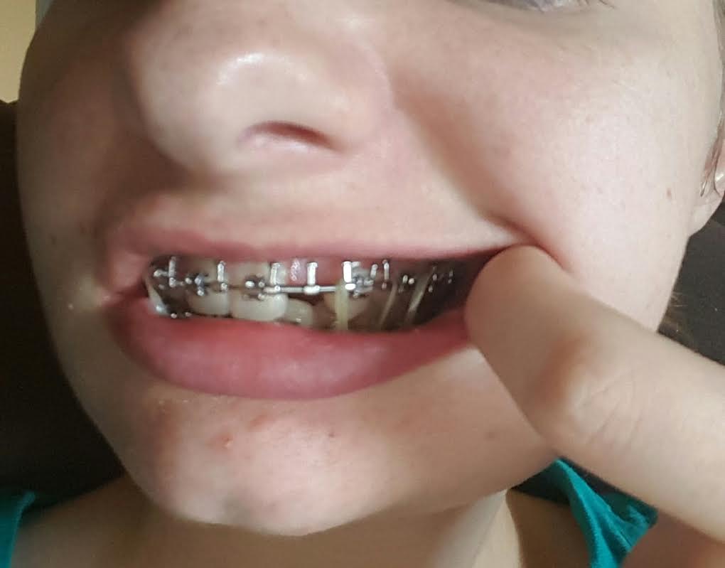 Jaw Surgery Experience and Recovery September 2016