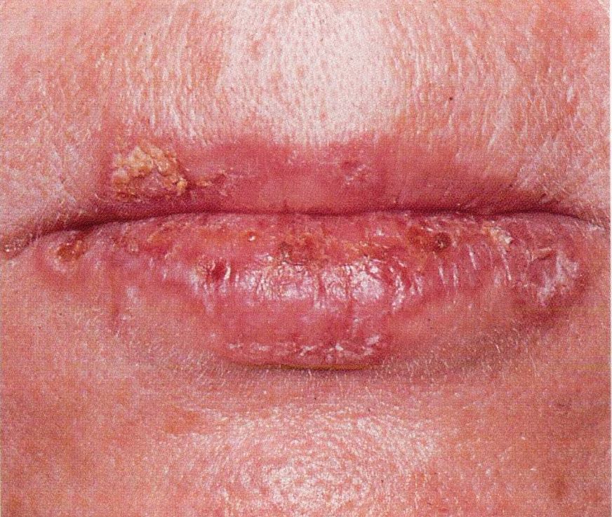 Common Oral Lesions: Part II. Masses and Neoplasia ...