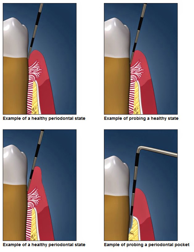 Cornerstone Dental Care Periodontal Probing
