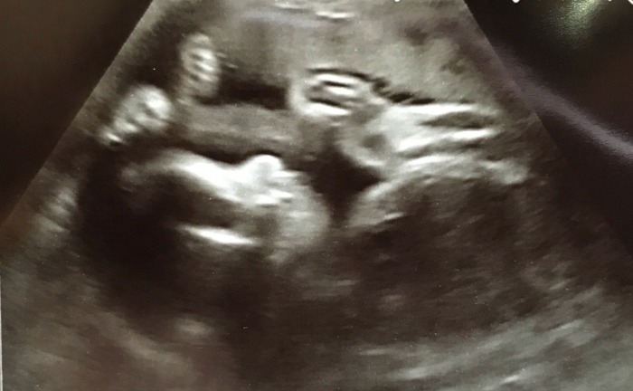 Dot in a scan at 31 weeks