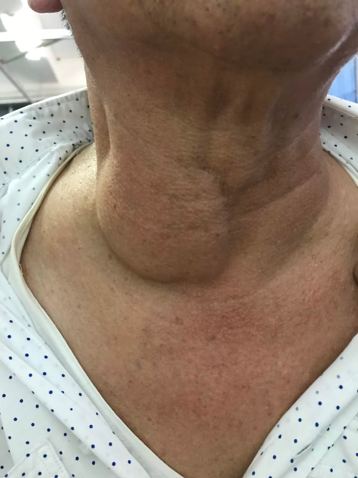 lipoma-ultrasound