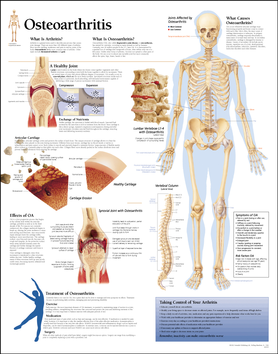 HUMAN BODY SYSTEM What is Osteoarthritis?