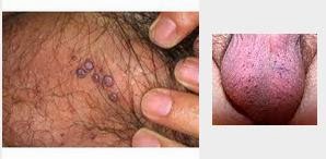 Obat Kutil Pada Buah Zakar