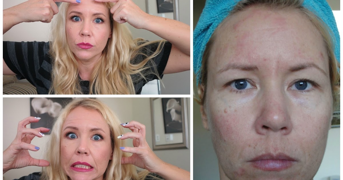 25 YEARS OF SKIN PICKING AND TIPS TO AVOID IT DERMATILLOMANIA