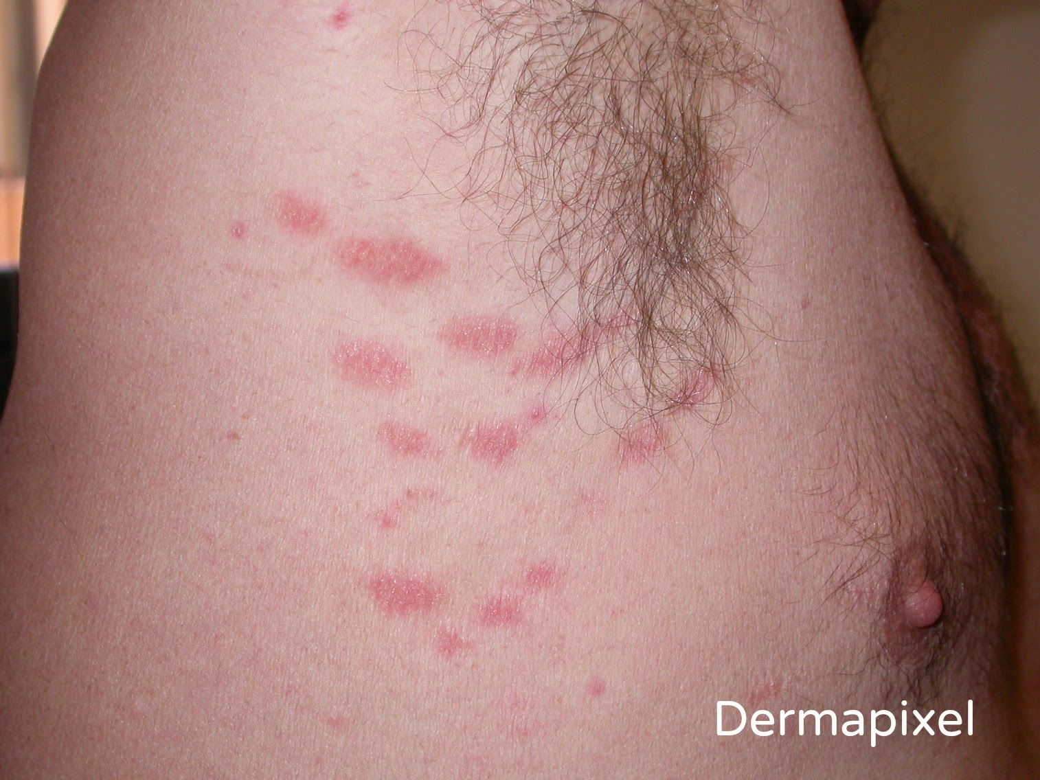 Atopic dermatitis (eczema) - Mayo Clinic
