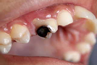 5 Cara Menghilangkan Bau Mulut Akibat Gigi Berlubang Paling Efektif 