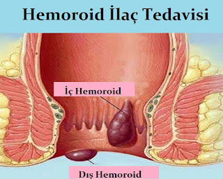 Hemoroid İlaç Tedavisi