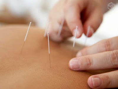 Acupuntura - Clínica em São Jose SC (48) 3094-5746 - Atendimento de segunda a sábado com hora marcada Acupuntura - Clínica em São Jose SC (48) 3094-5746 - Atendimento de segunda a sábado com hora marcada