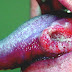 Oral Cancer - Human Tongue Diseases