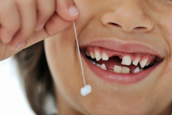 Có nên nhổ răng sữa ở trẻ em ?