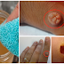 Tolong Sebar Luaskan..!!! Bagi Anda yang Punya Tumor Fibroid/Kulit Berlebih di Tubuh, Tenang Jangan Cemas..!!!!! Begini Cara Menghilangkannya : Semoga Info'Nya Bermanfaat"..