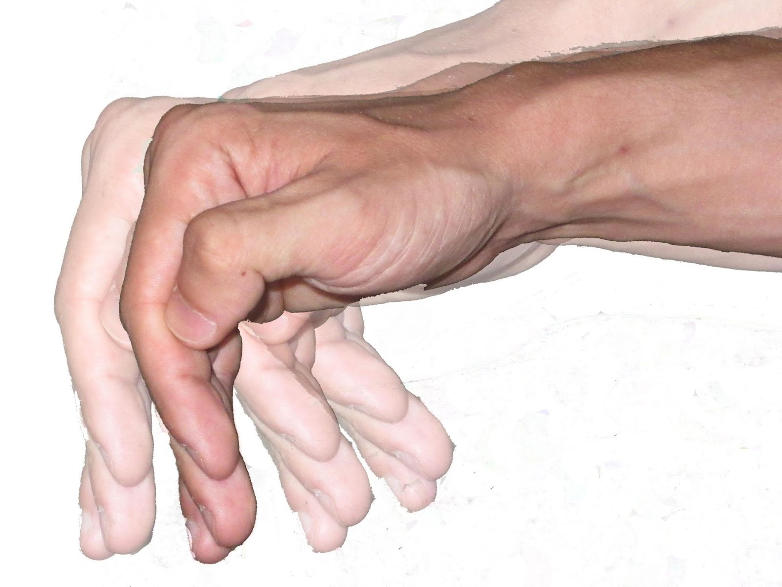 Mengenal Parkinson Dan Dopamin