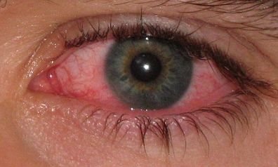 red on eyelid #9