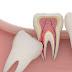 Nhổ răng khôn nên thực hiện khi nào ?