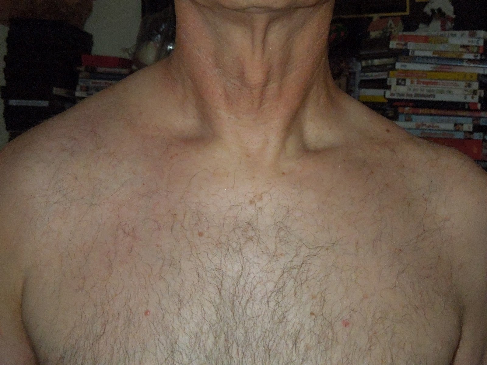 swollen neck lymph nodes