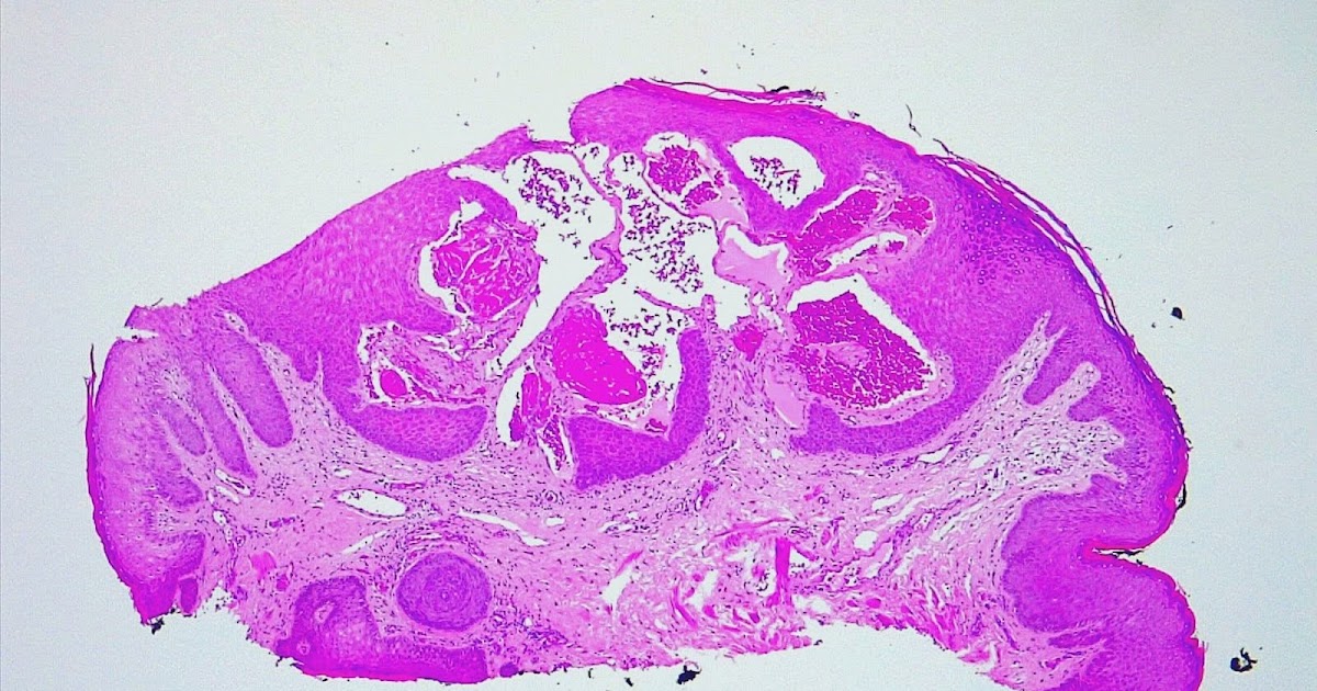 Dermapixel Angioqueratomas de Fordyce