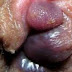 Obat Salep Ampuh Menghilangkan Benjolan Wasir di Anus thumbnail