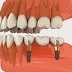 Ai nên thực hiện cấy ghép răng implant ?