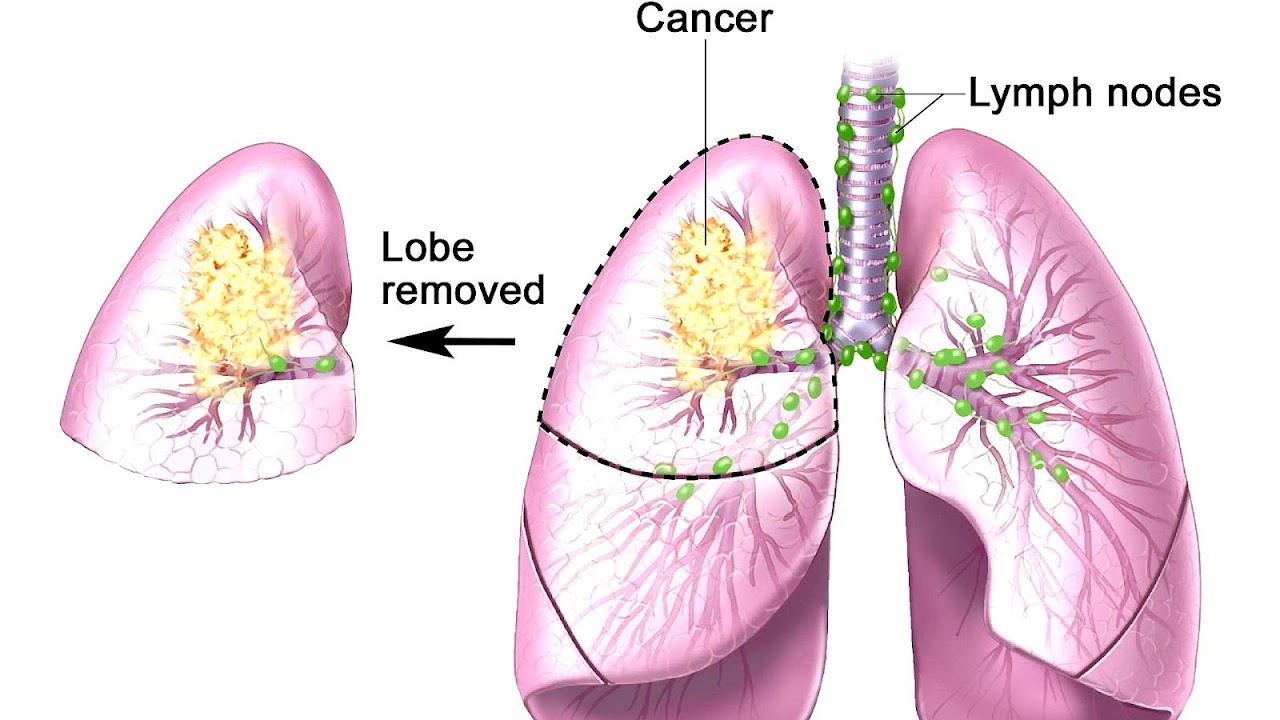 Photodynamic Therapy Lung Cancer  Photo Choices