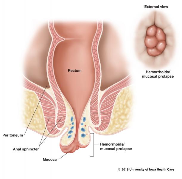 Hemorroides internas trombosadas sintomas Hemorroides internas trombosadas sintomas