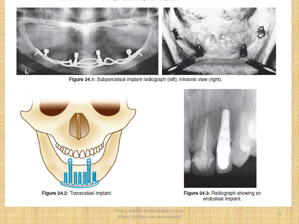 Dental Notes Dental Implant Materials NOTES (new)