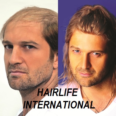 protez sac protez sac istanbul protez sac ankara aralik 2016