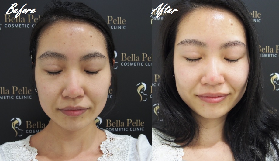 Lily Not Louise Aqua Peel H2 Toning Bella Pelle Cosmetic Clinic Sydney