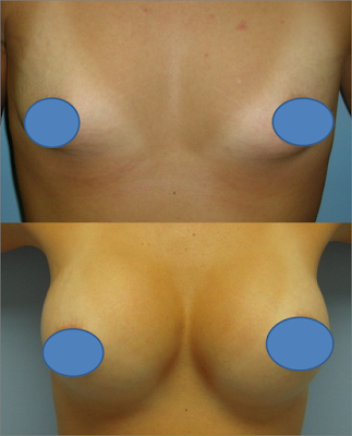 Antes e Depois Mamoplastia de Aumento Antes e Depois Mamoplastia de Aumento