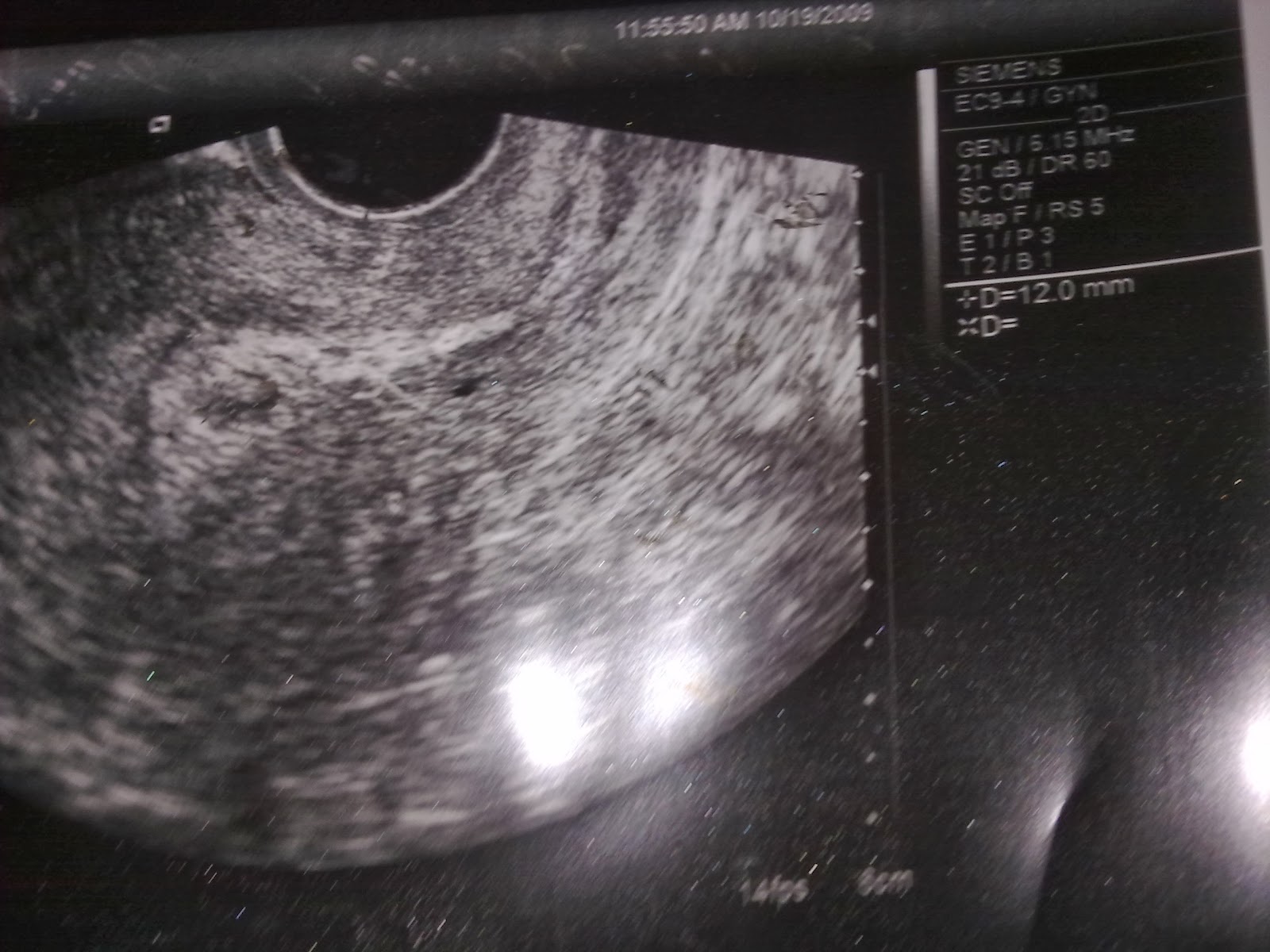 Плодное яйцо 13,2 мм. Плодное яйцо 5 мм. Плодное яйцо 5 мм. Плодное яйцо 5 мм. Узи 5.