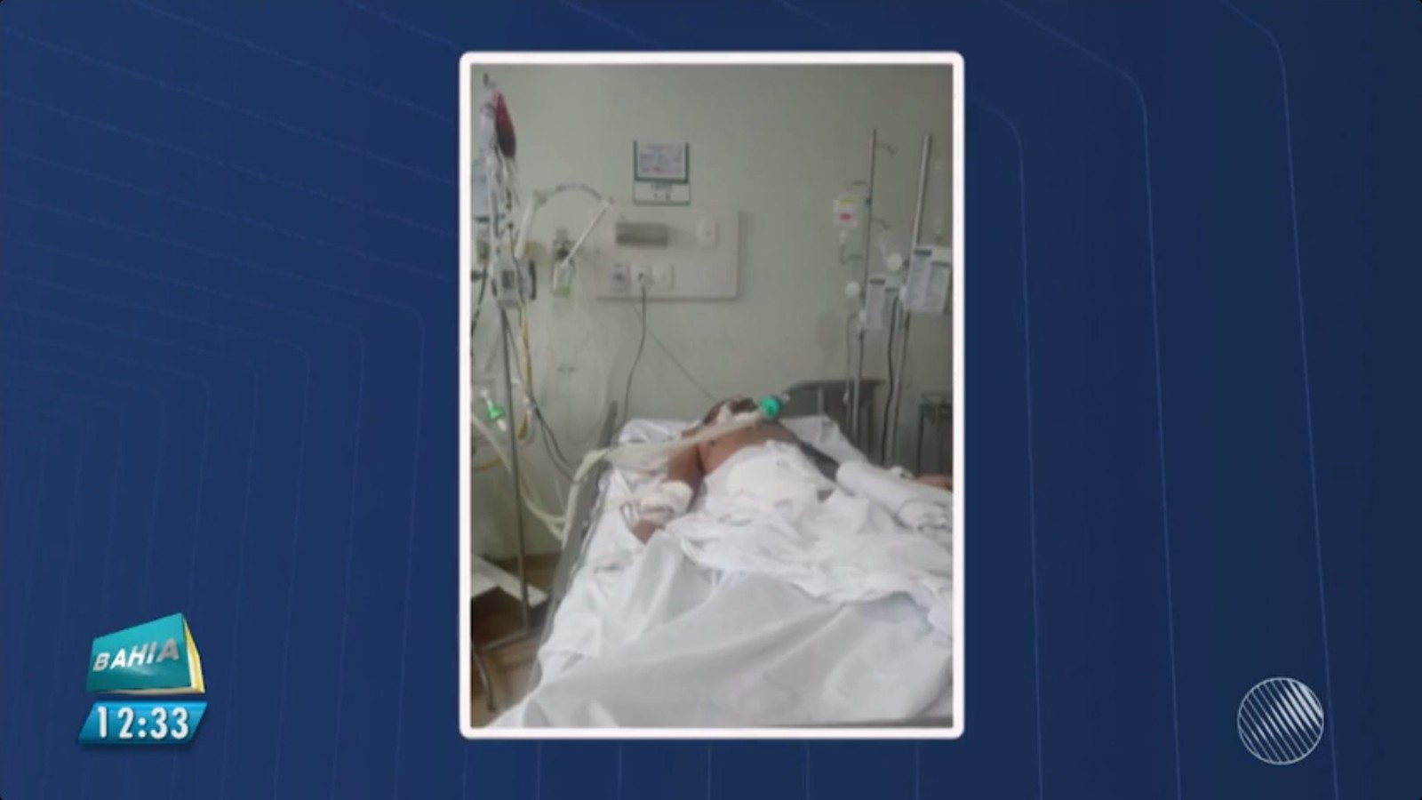 Paciente diagnosticado com Guillain-Barré morre em Feira de Santana