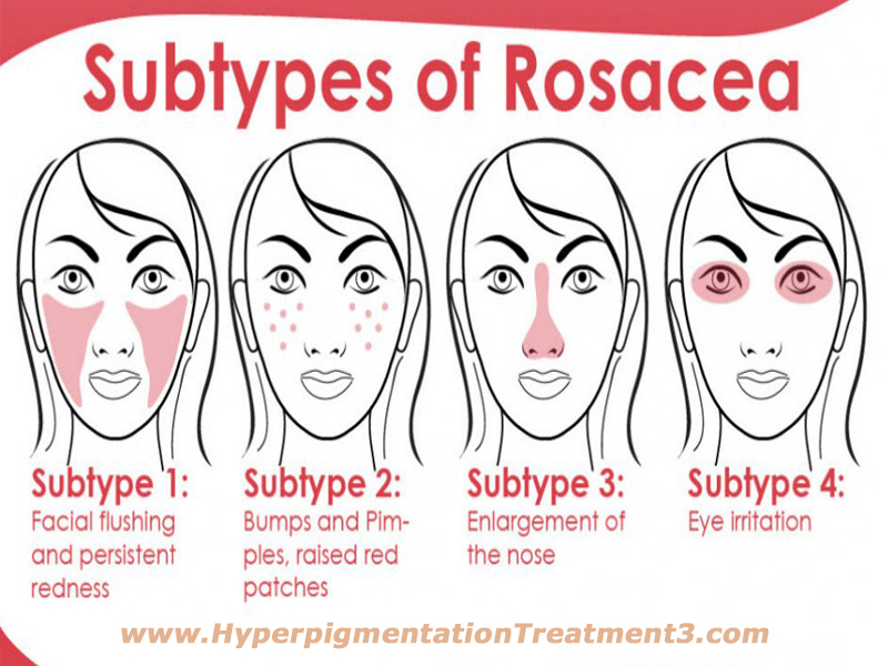 rosacea types