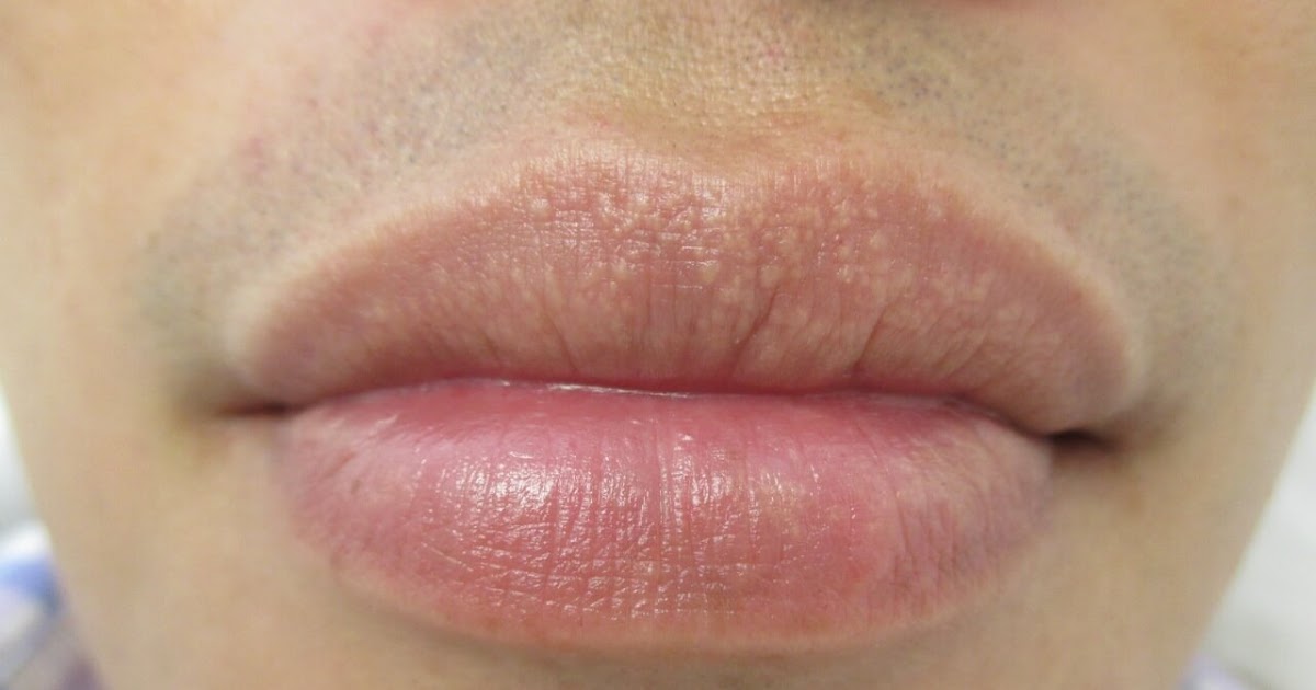 Me han salido unos bultitos en el labio Casos Clínicos