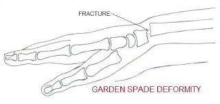 Eponymous Fractures Of Upper Limb