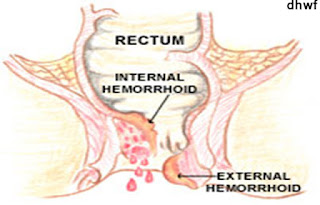 r Haemorrhoids, Varicosis and related problems