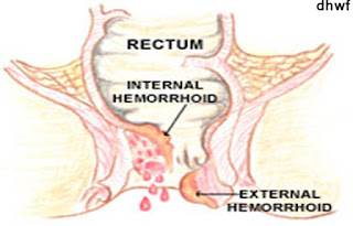 web r Haemorrhoids, Varicosis and related problems