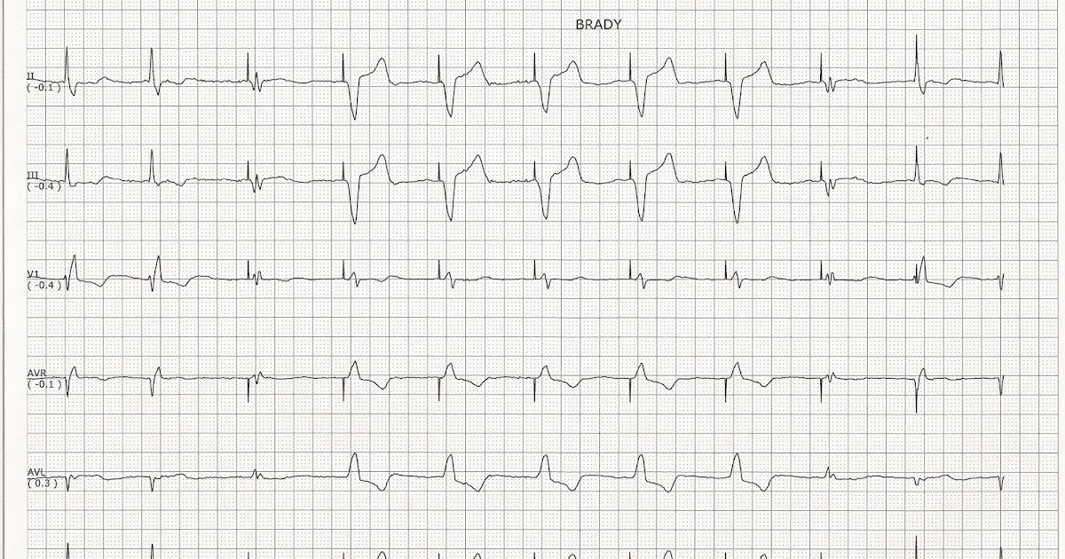Float Nurse Ventricular paced with some fusion complexes