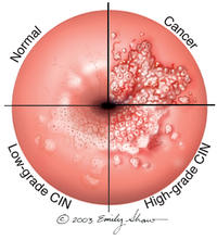 papilloma virus lesioni precancerose genital warts and pregnancy uk